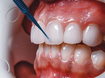 Composite Bonding at The Waterfront Clinic Greenock