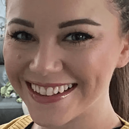 Before Invisalign Smile at The Waterfront Clinic Greenock