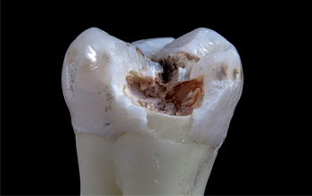 Broken Teeth at The Waterfront Clinic Greenock