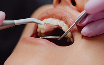 Dental Bleeding at The Waterfront Clinic Greenock