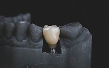 Dental Crown at The Waterfront Clinic Greenock