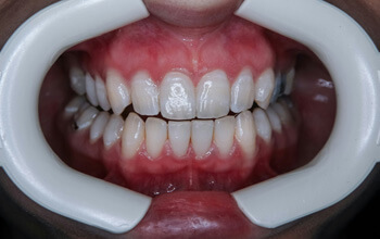 Teeth Mould at The Waterfront Clinic Greenock